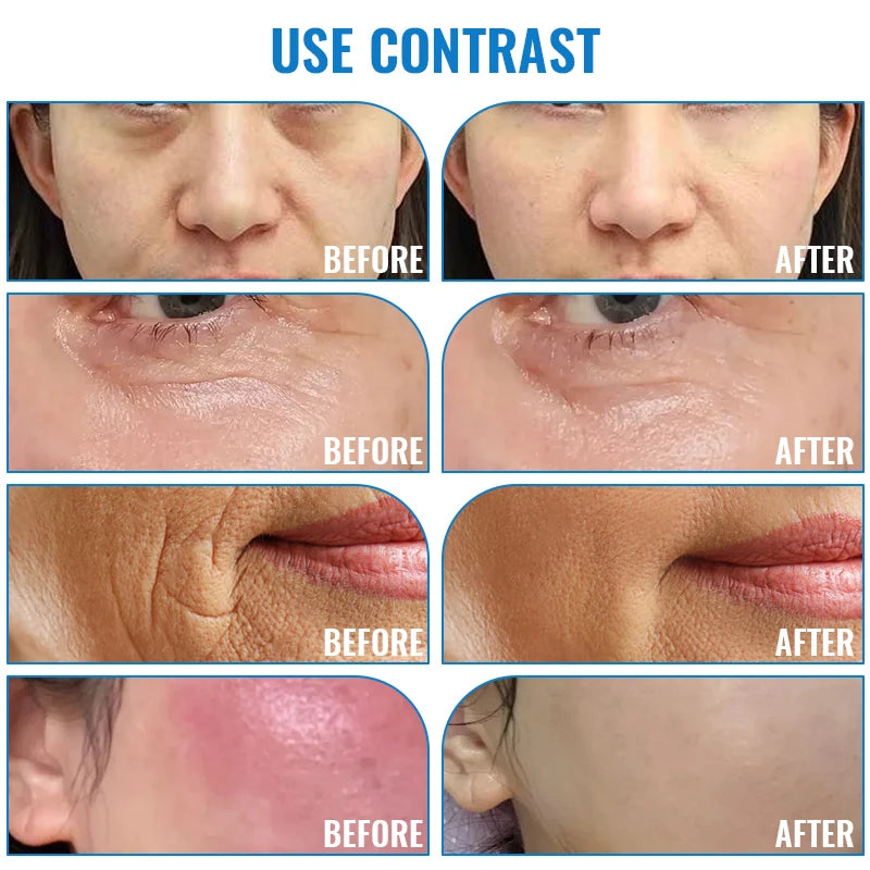 radio-frequency-facial-lifting-machine-dot-matrix-wrinkle-removal-skin-tightening-high-frequency-facial-care-massager-device-us